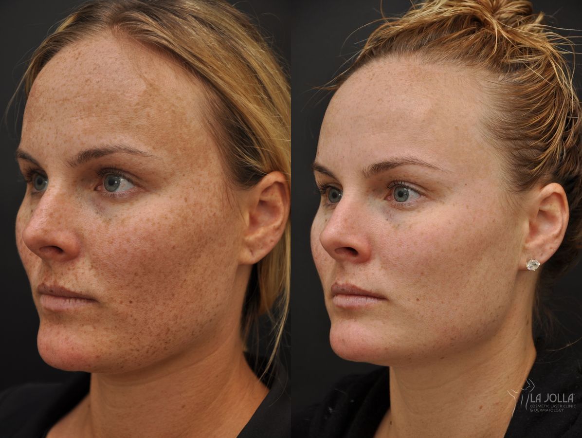 Before and after Chemical Peel case 36241 - Angle 2