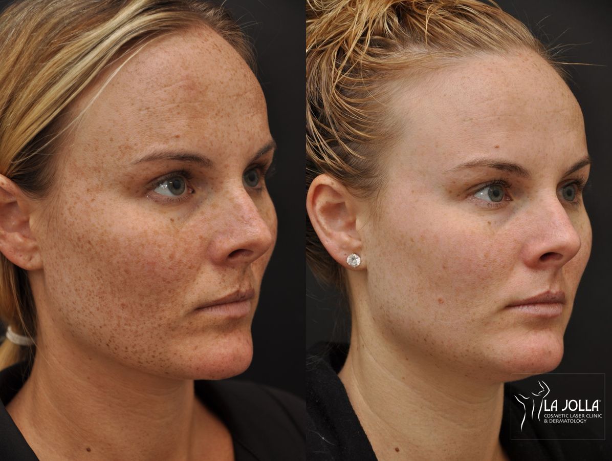 Before and after Chemical Peel case 36241 - Angle 3