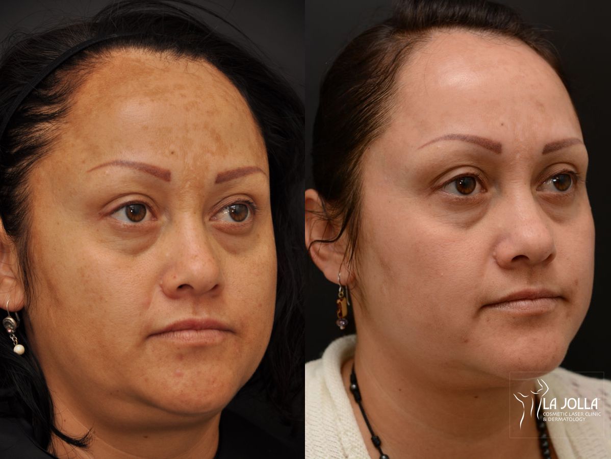 Before and after Chemical Peel case 36259