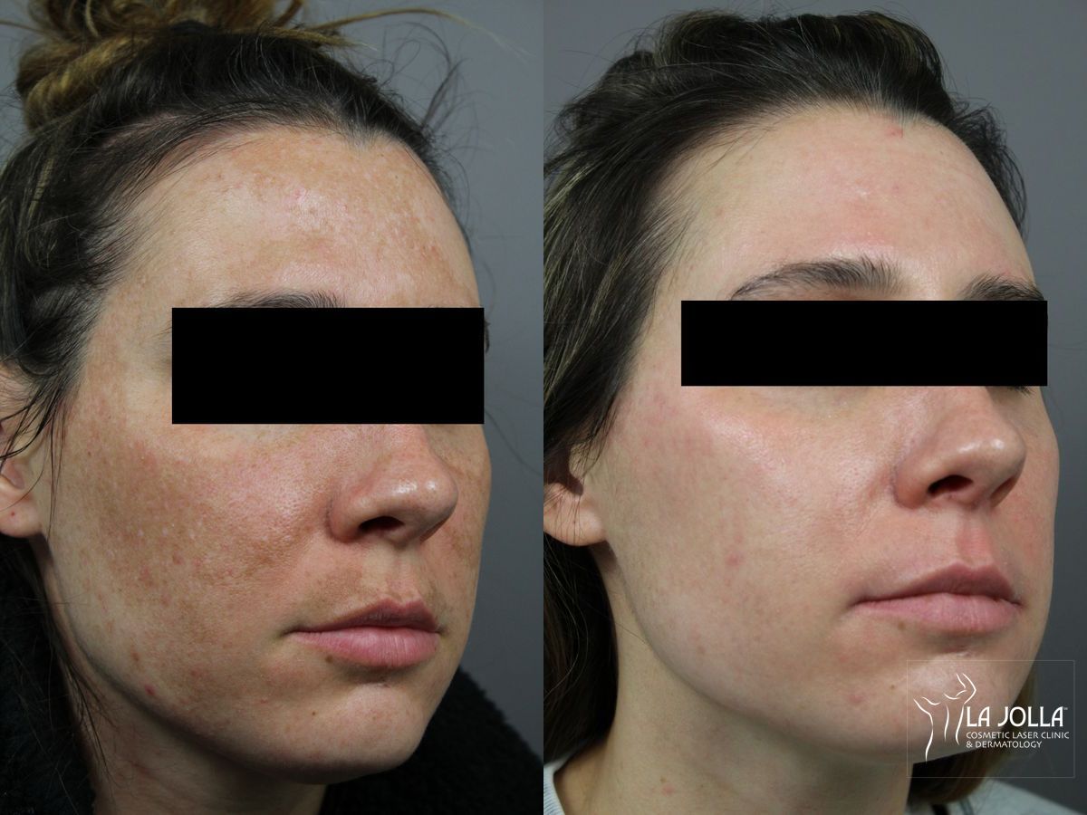 Before and after Chemical Peel case 36299 - Angle 2