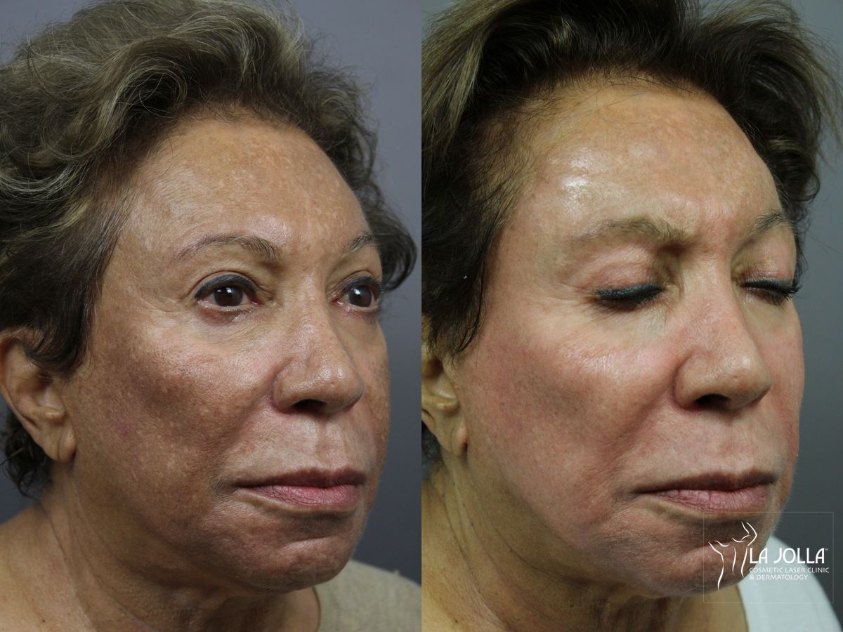 Before and after Chemical Peel case 36149