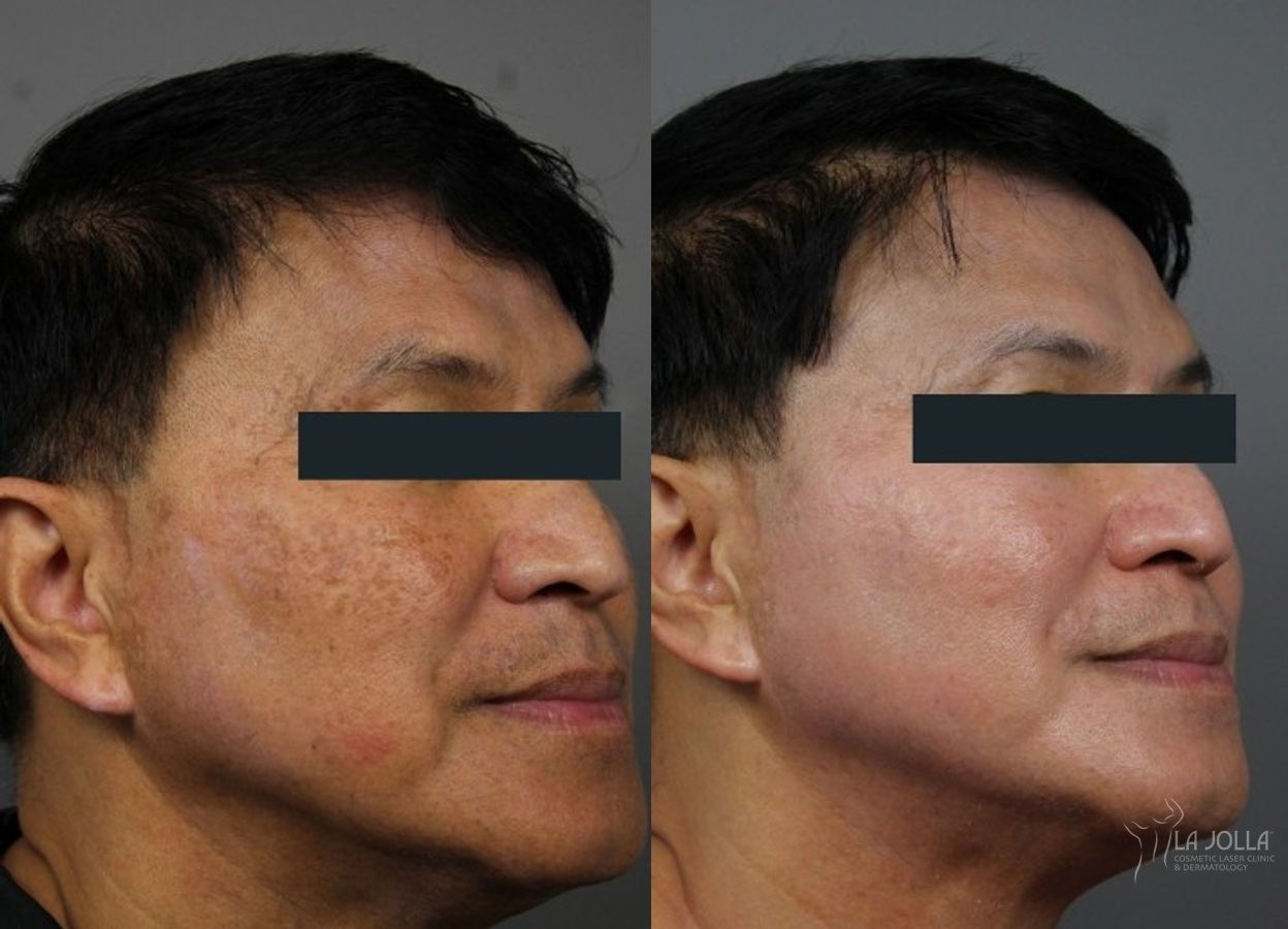 Before and after Chemical Peel case 36270 - Angle 2