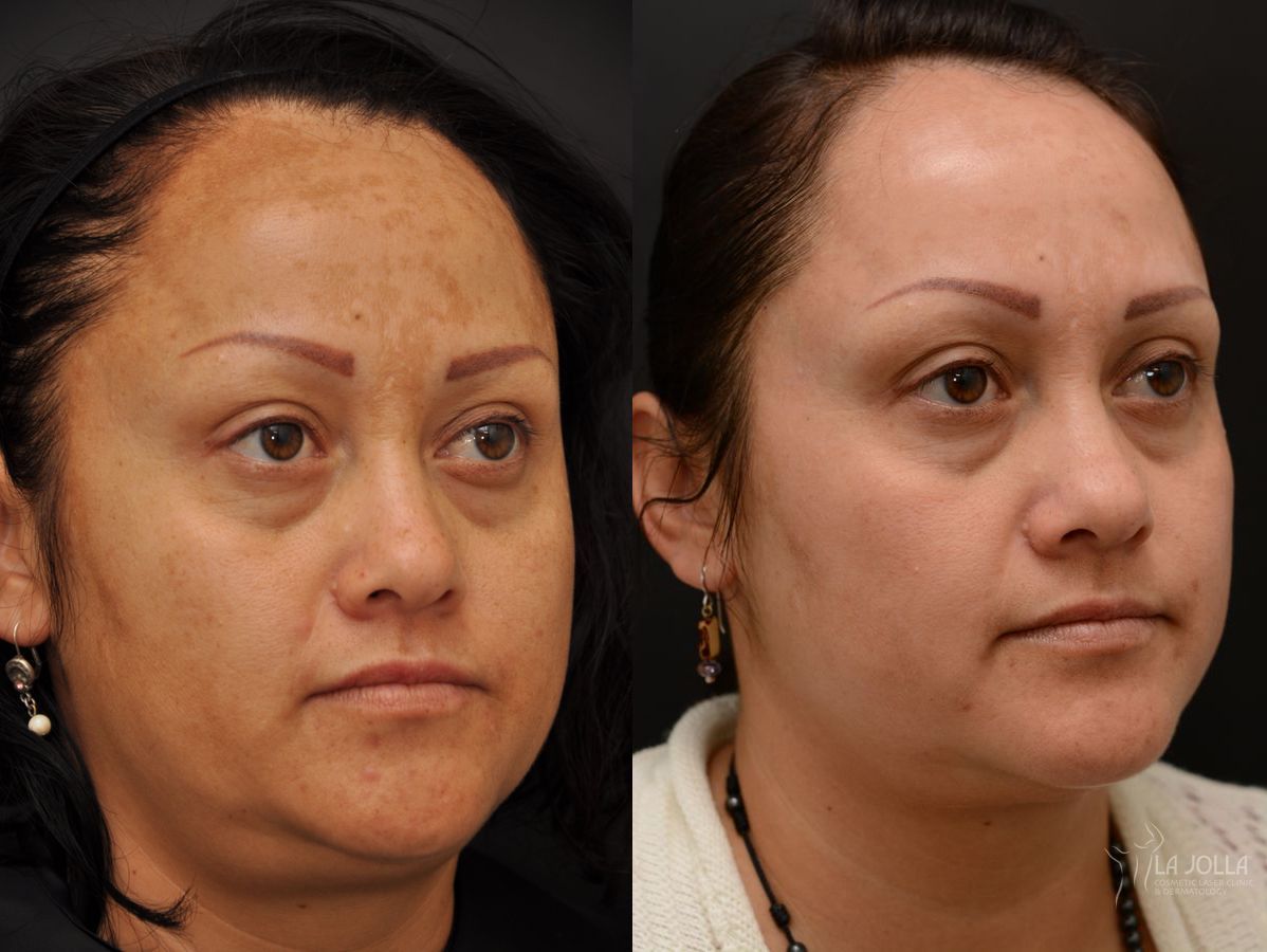 Before and after Chemical Peel case 36259
