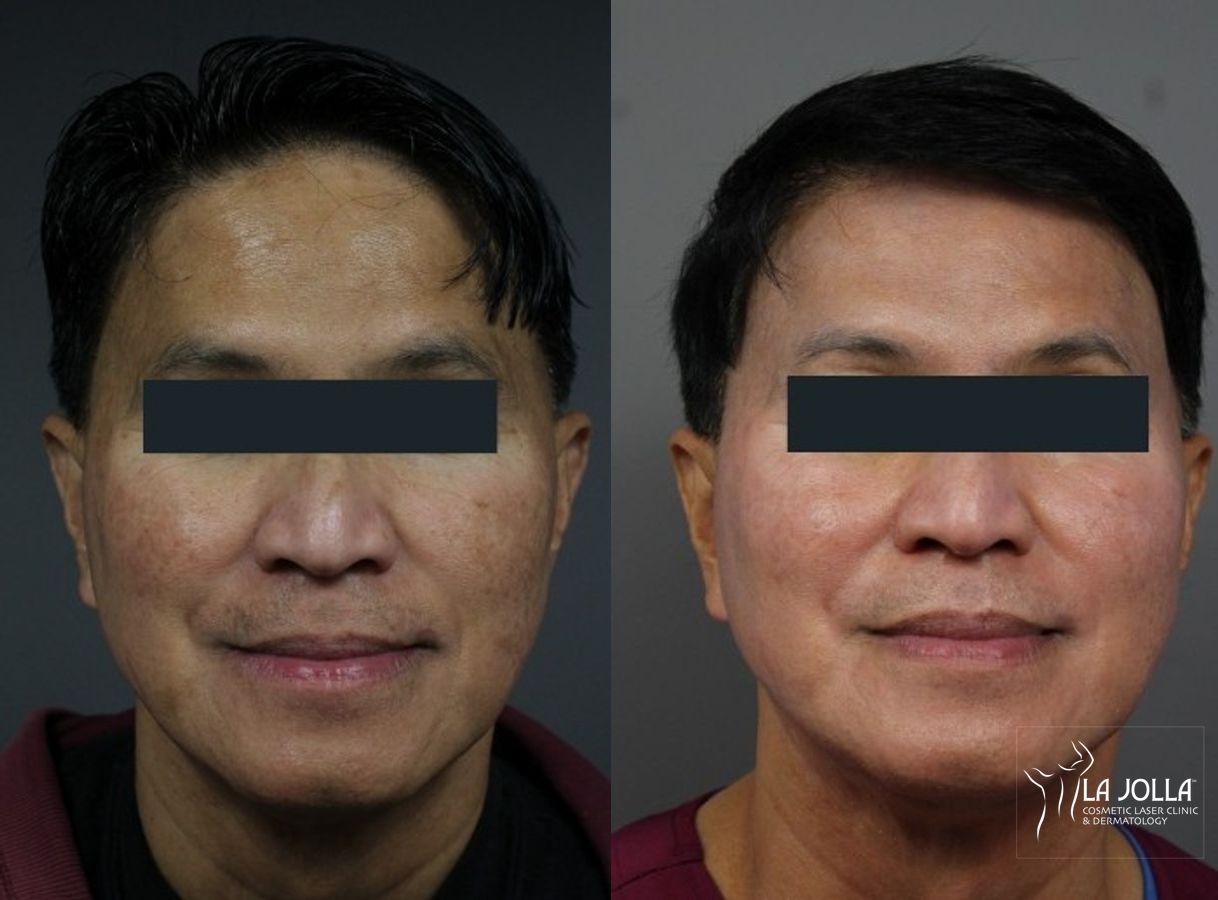 Before and after Chemical Peel case 36270