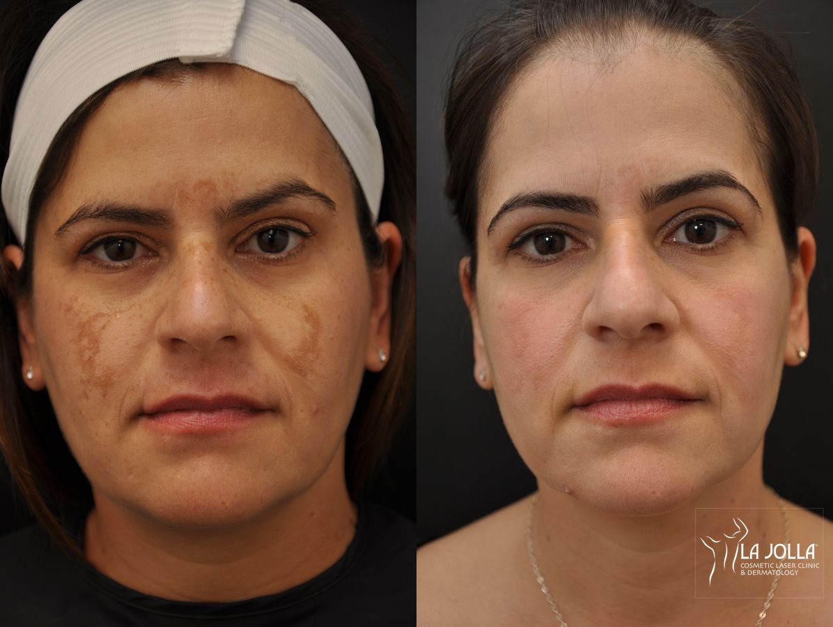 Before and after Chemical Peel case 36233