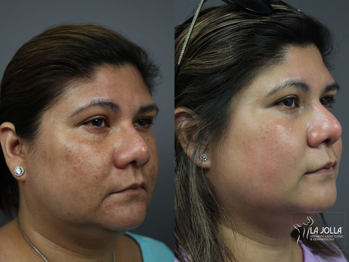Before and after Chemical Peel case 36181 - Angle 2