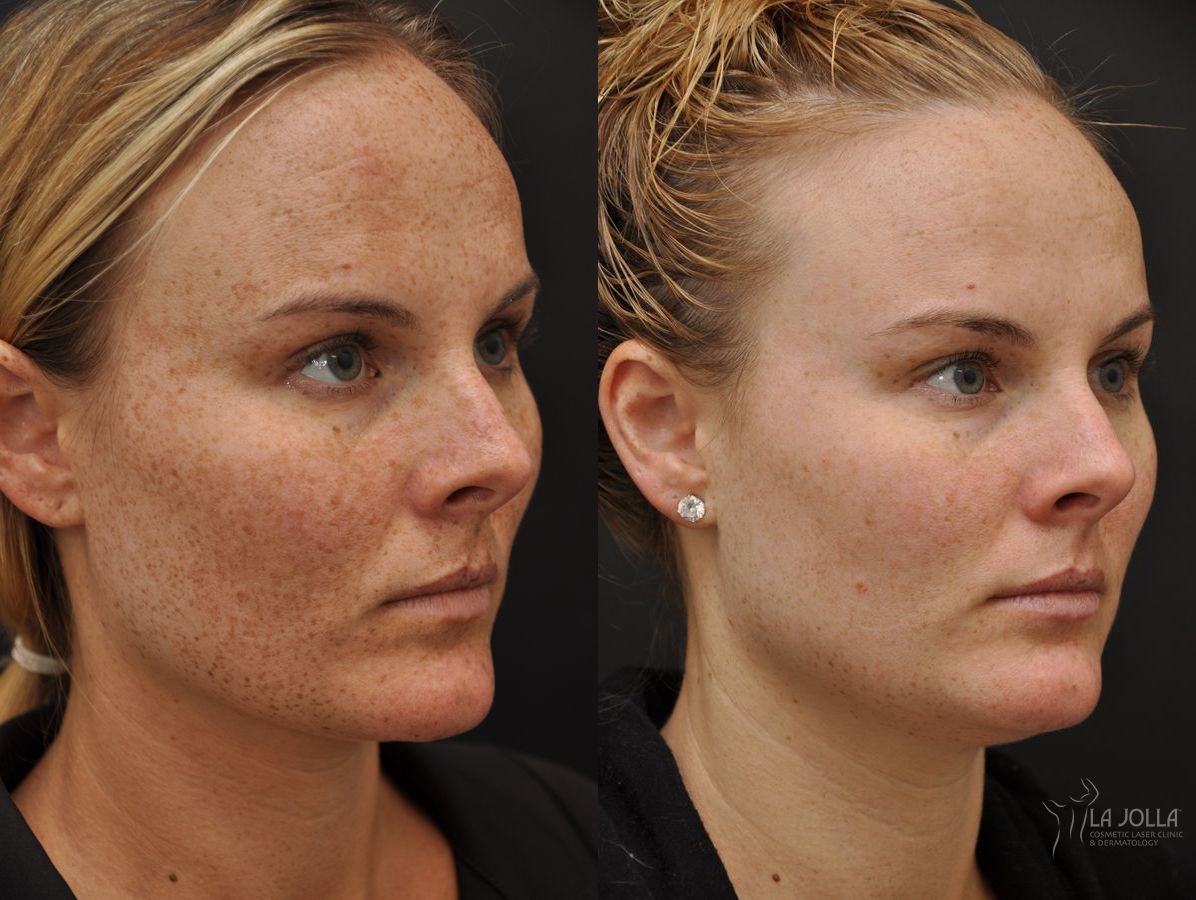 Before and after Chemical Peel case 36241 - Angle 3