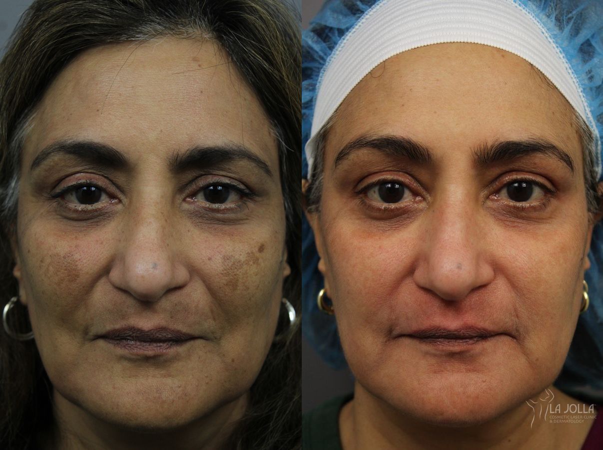 Before and after Chemical Peel case 36281