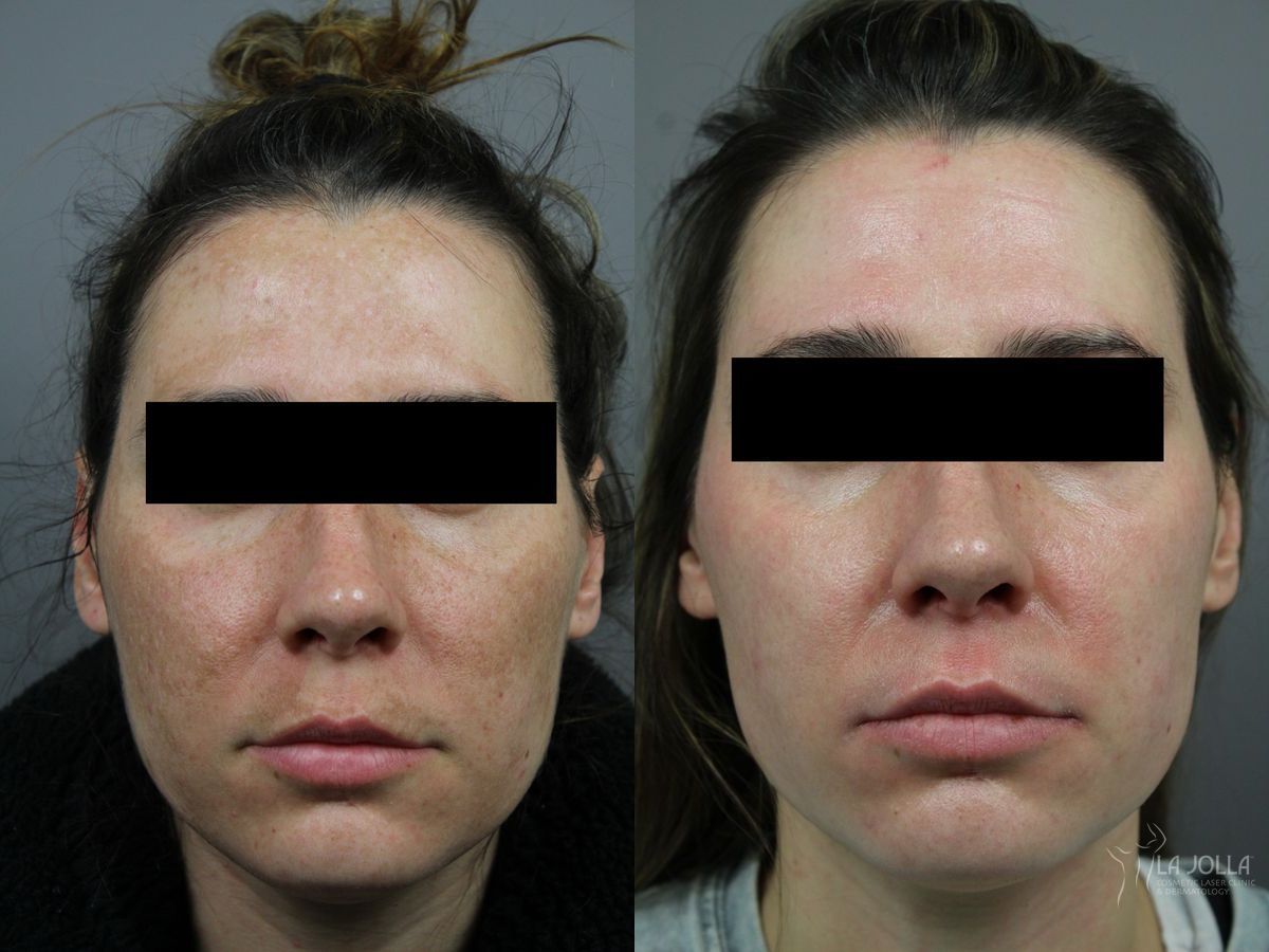 Before and after Chemical Peel case 36299