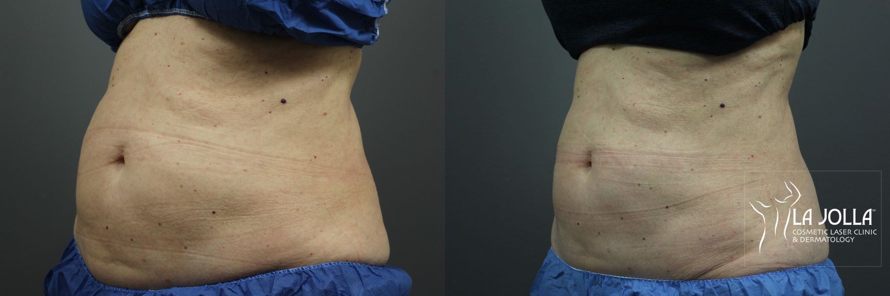 Before and after CoolSculpting® case 36255