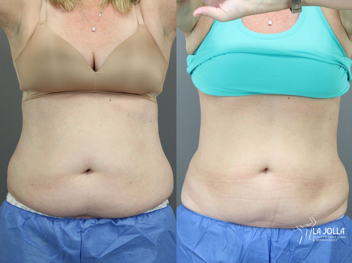 Before and after CoolSculpting® case 36130