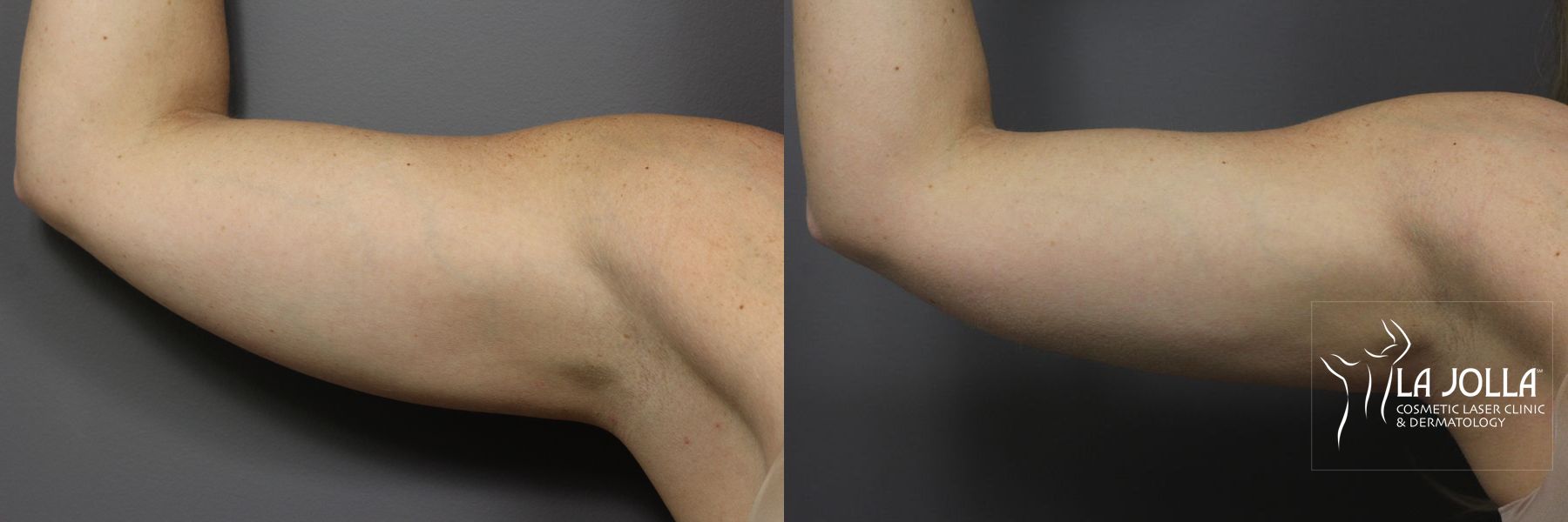Before and after CoolSculpting® case 36116