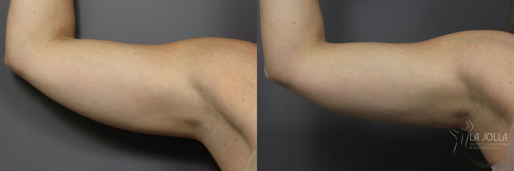 Before and after CoolSculpting® case 36116