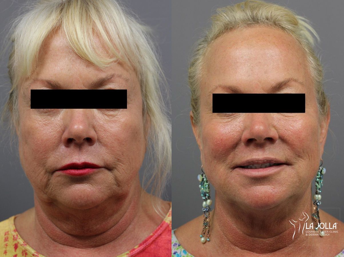 Before and after CoolSculpting® case 36291
