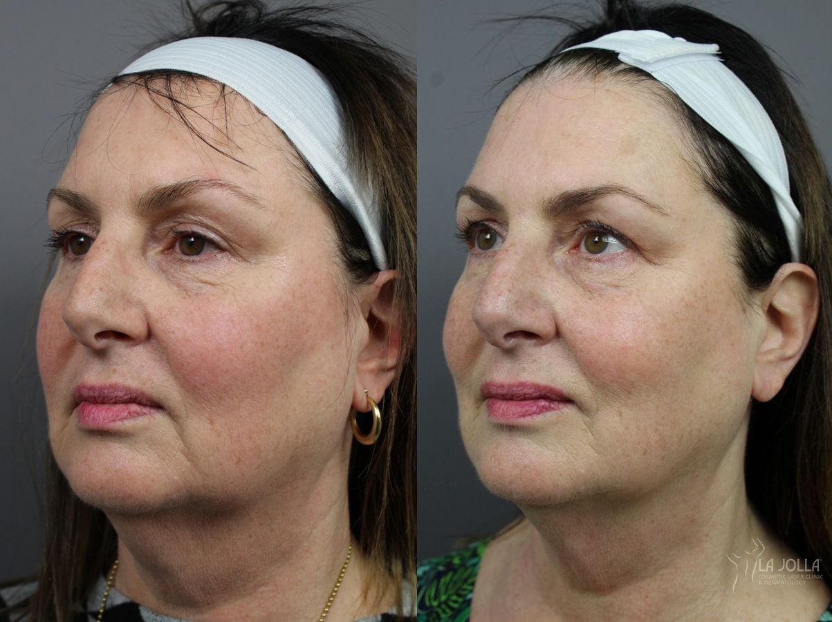 Before and after CoolSculpting® case 36165
