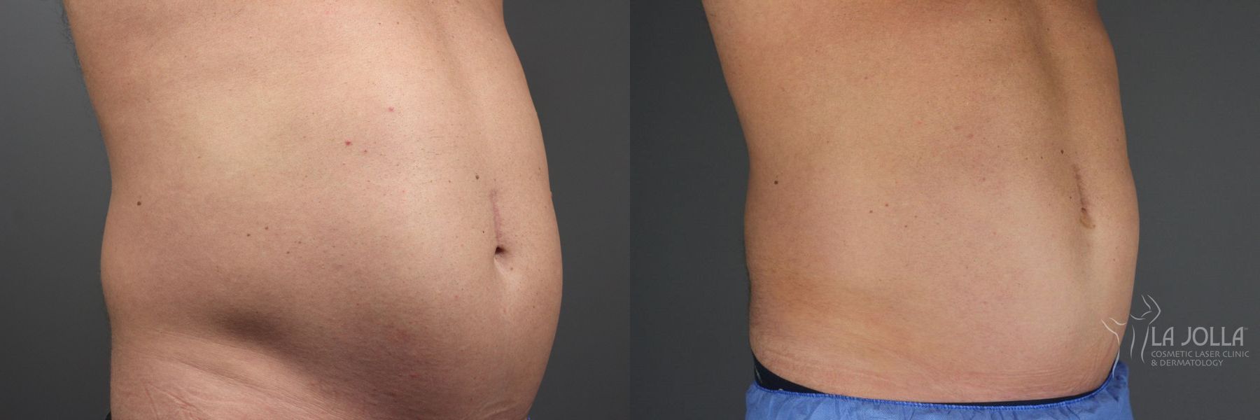 Before and after CoolSculpting® case 36287