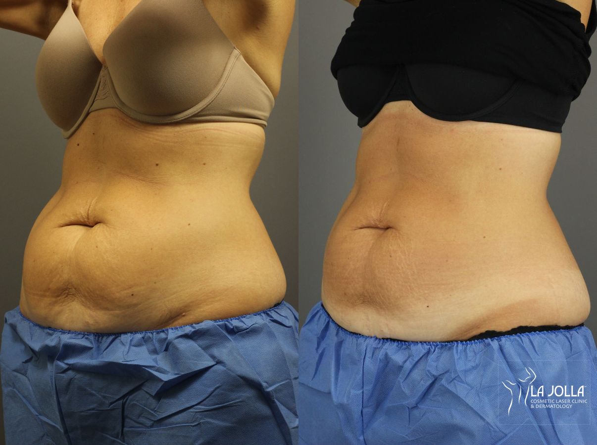 Before and after CoolSculpting® case 36204 - Angle 2