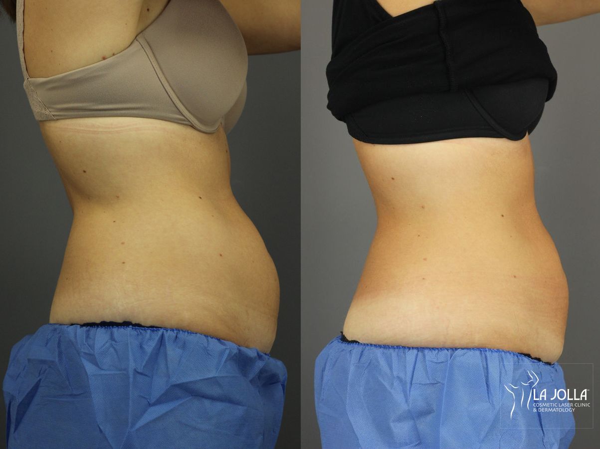 Before and after CoolSculpting® case 36204 - Angle 3