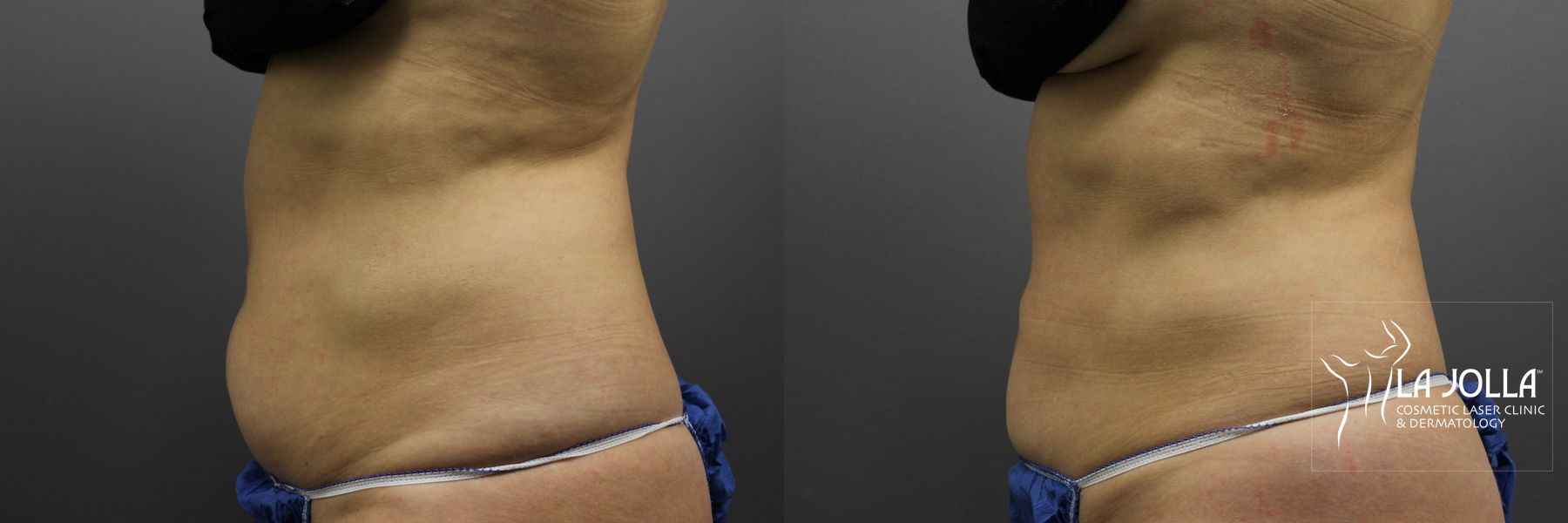 Before and after CoolSculpting® case 36180 - Angle 2