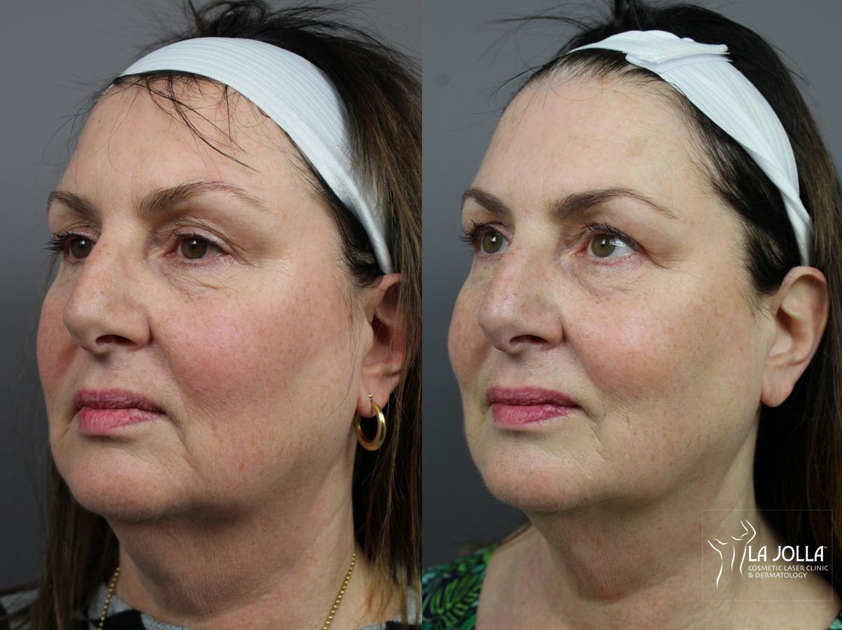 Before and after CoolSculpting® case 36165