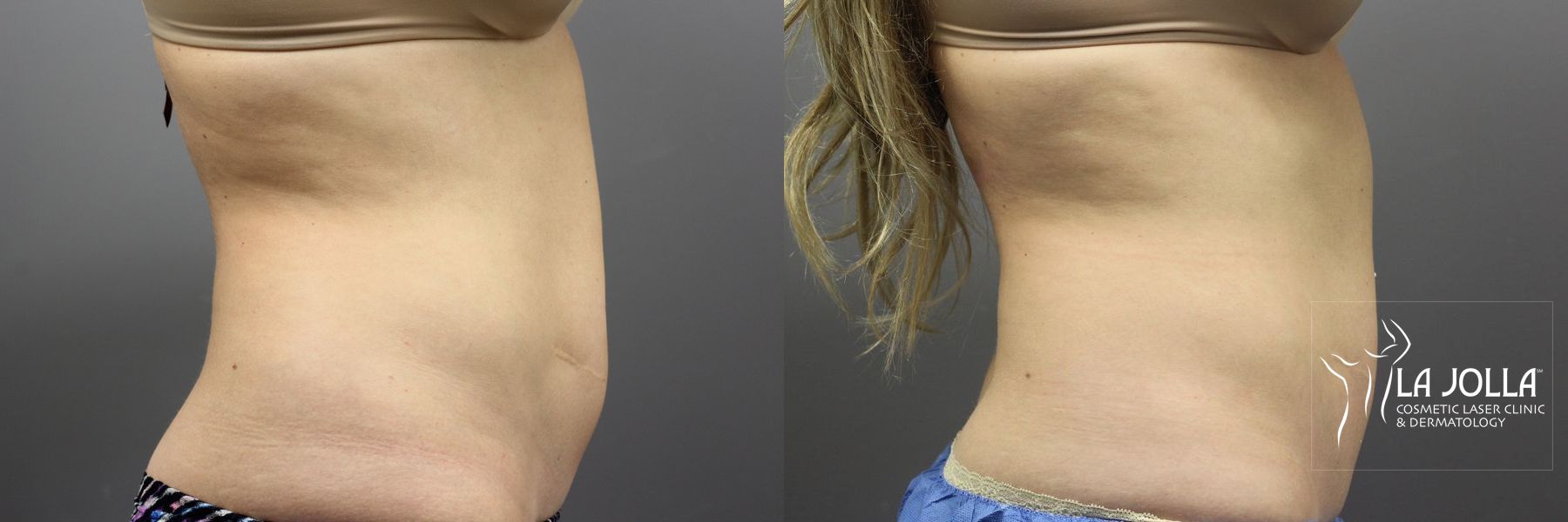 Before and after CoolSculpting® case 36101 - Angle 3