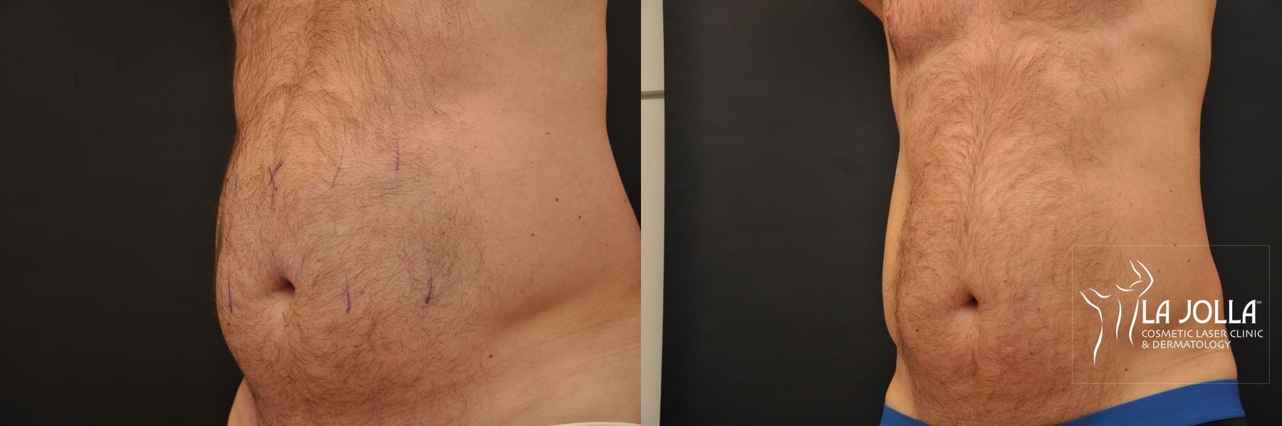 Before and after CoolSculpting® case 36272