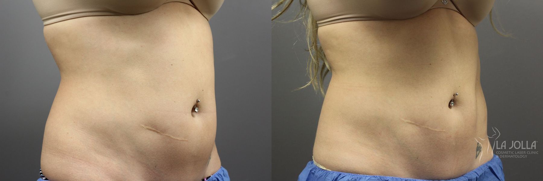 Before and after CoolSculpting® case 36101