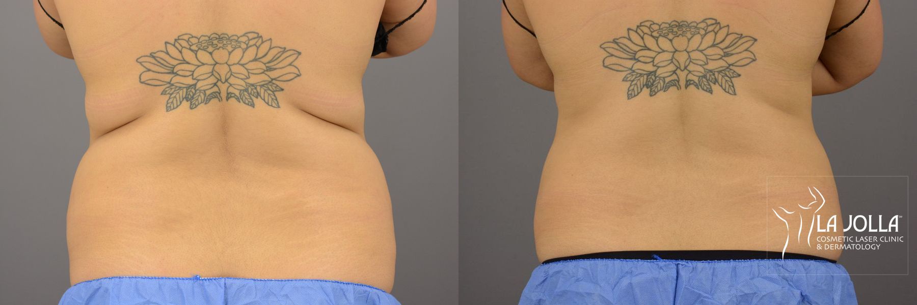 Before and after CoolSculpting® case 36289