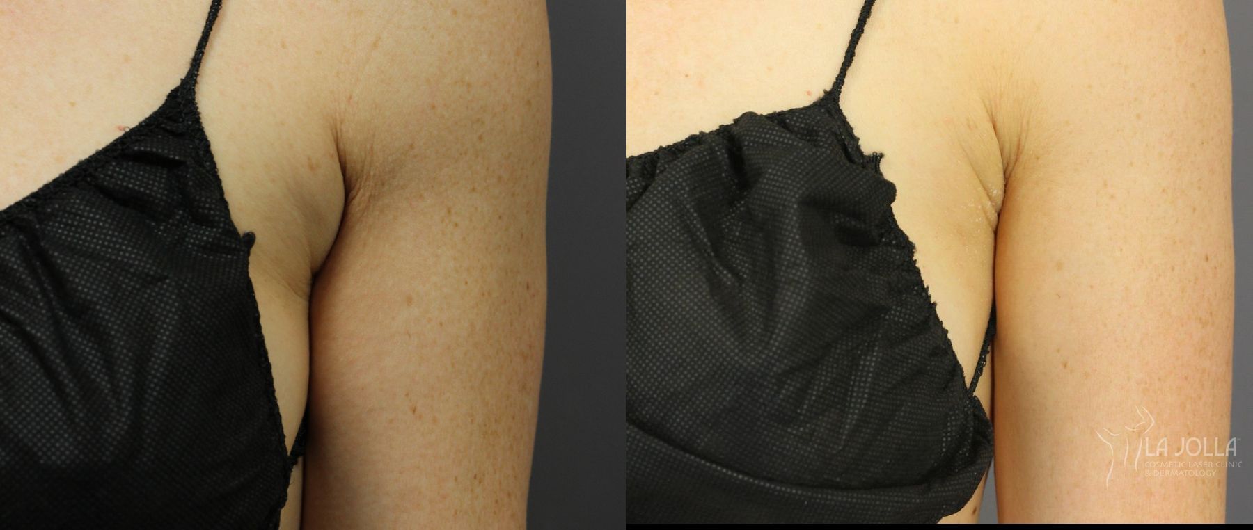 Before and after CoolSculpting® case 36276