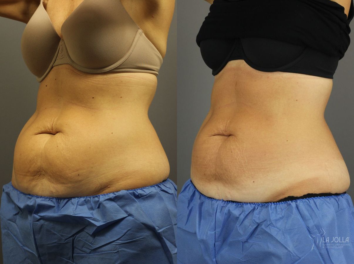 Before and after CoolSculpting® case 36204 - Angle 2