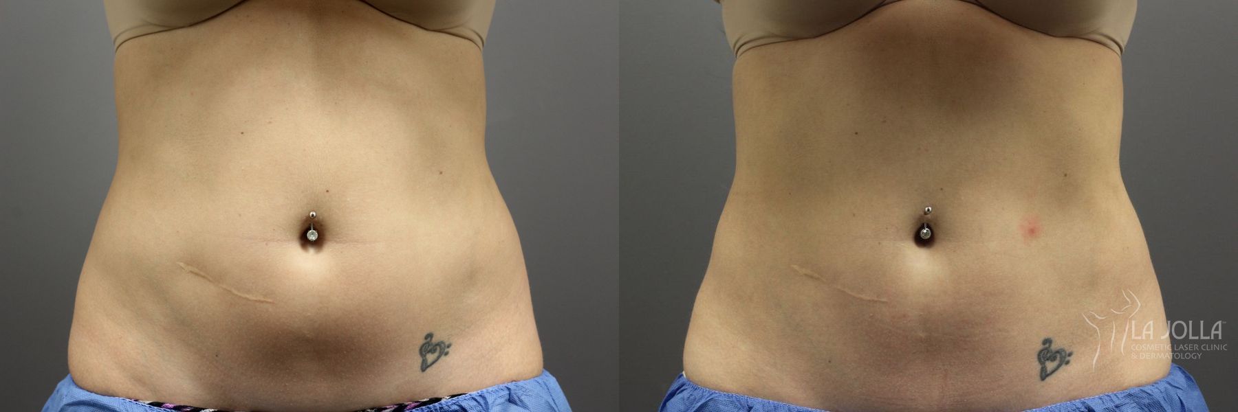 Before and after CoolSculpting® case 36101 - Angle 2