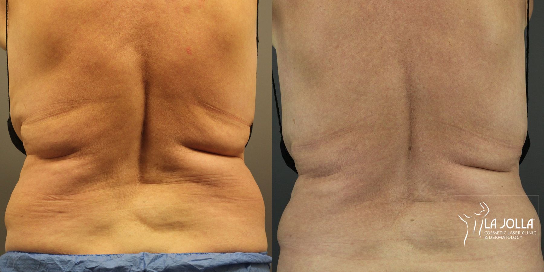 Before and after CoolSculpting® case 36239
