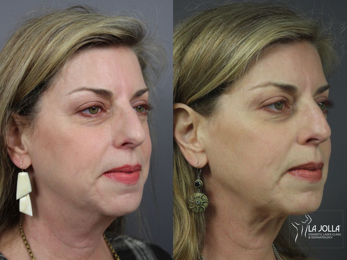 Before and after CoolSculpting® case 36084 - Angle 3