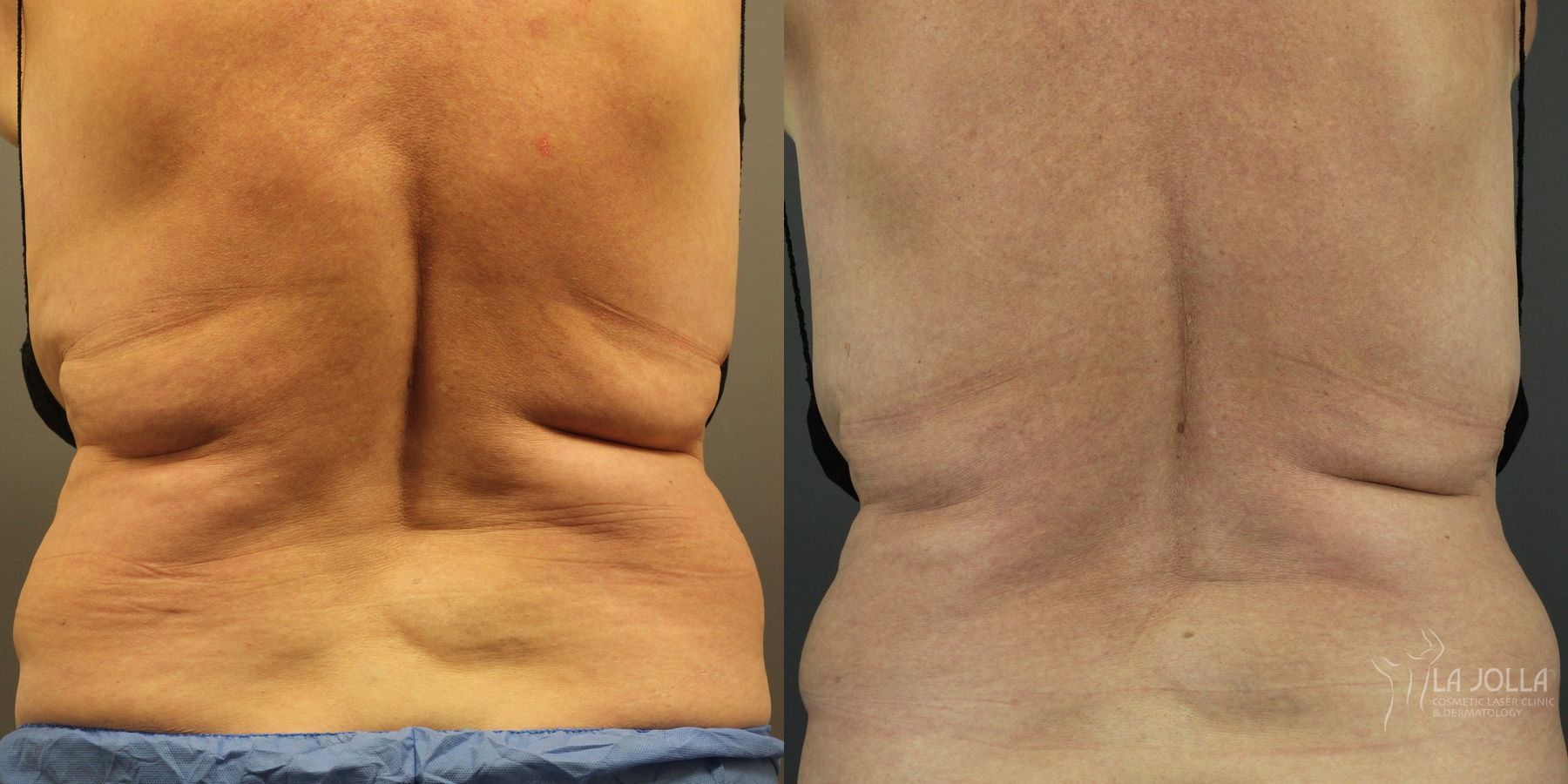 Before and after CoolSculpting® case 36239