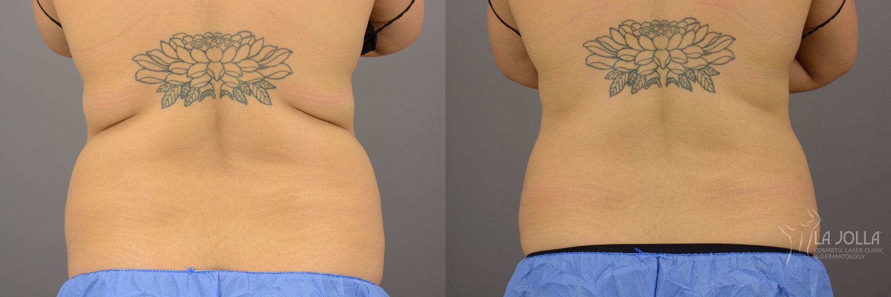 Before and after CoolSculpting® case 36289