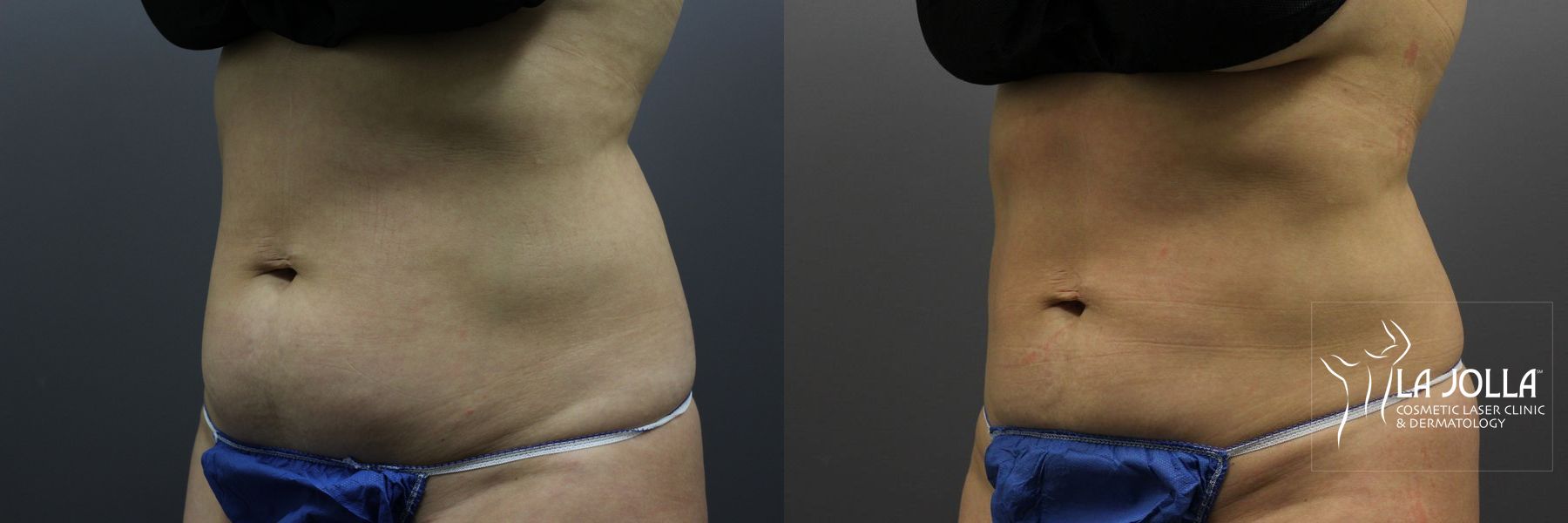 Before and after CoolSculpting® case 36180