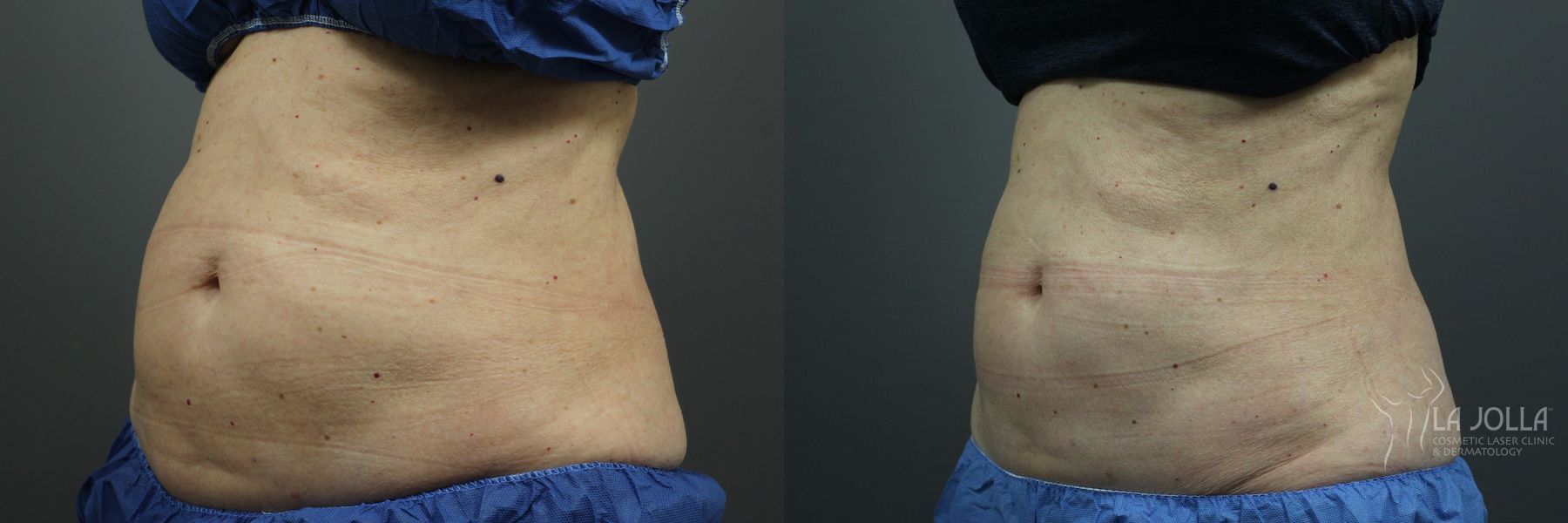 Before and after CoolSculpting® case 36255