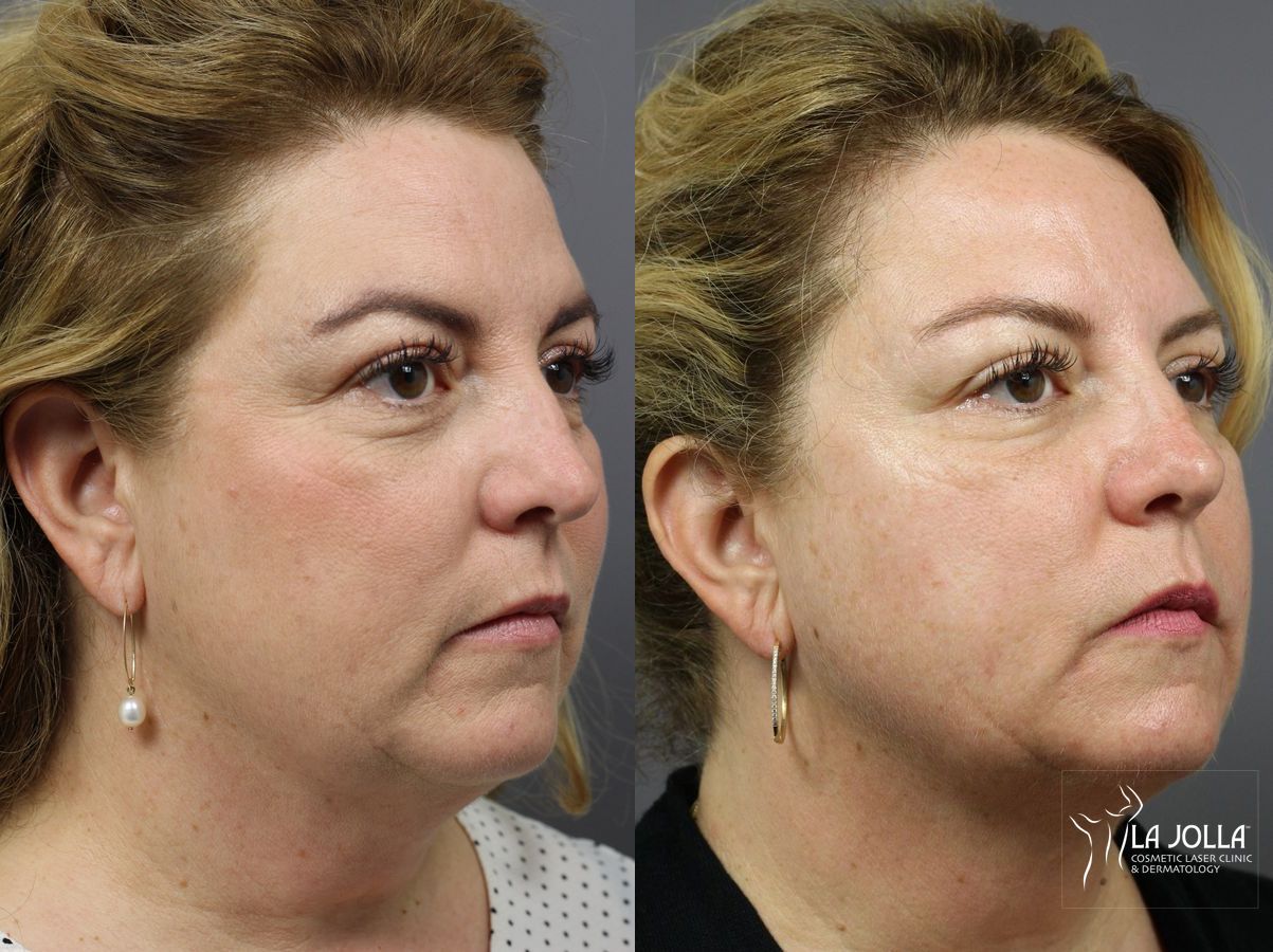 Before and after CoolSculpting® case 36214