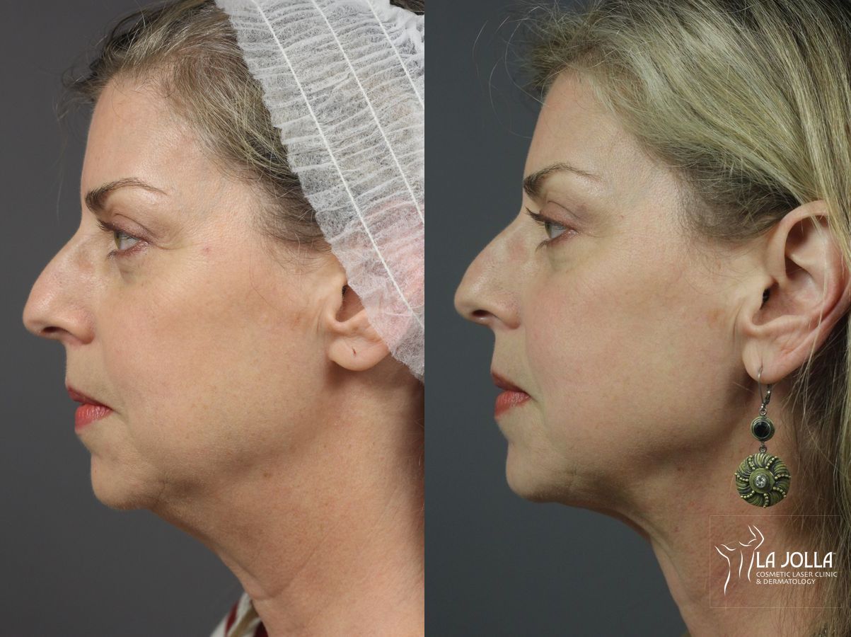 Before and after CoolSculpting® case 36084 - Angle 2