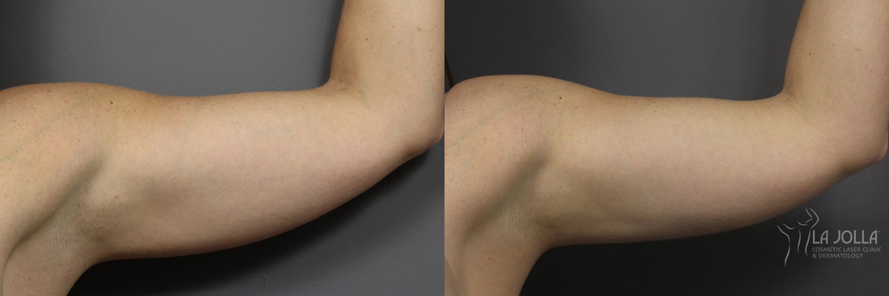 Before and after CoolSculpting® case 36116 - Angle 2