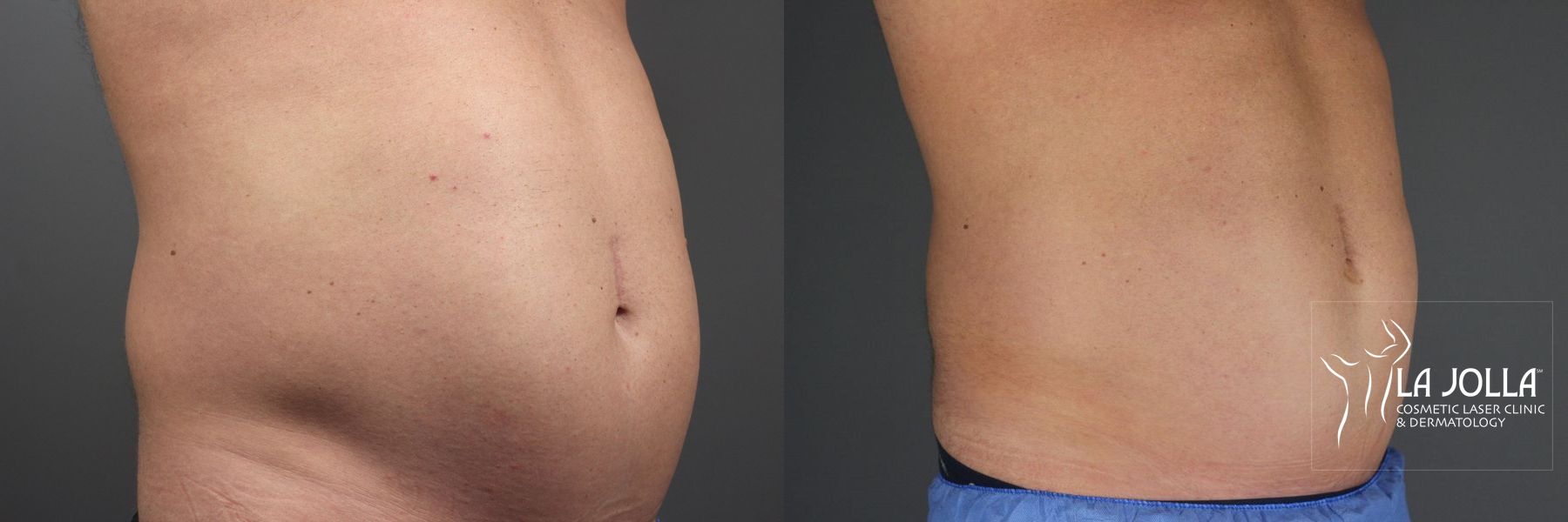 Before and after CoolSculpting® case 36287