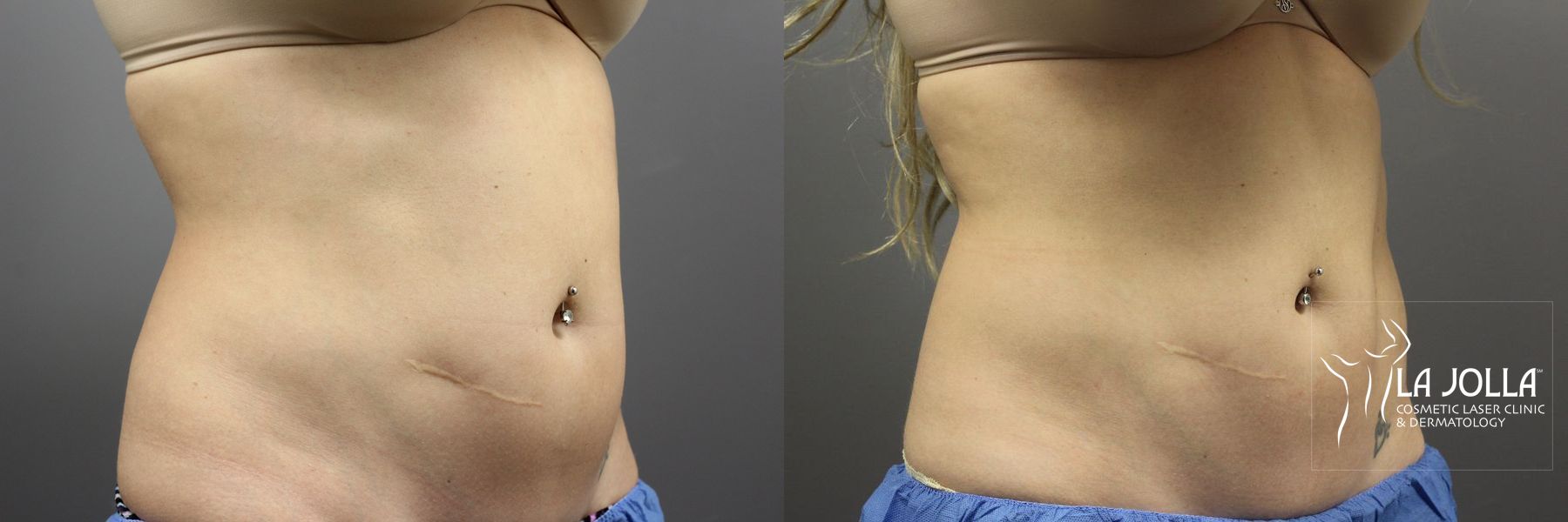 Before and after CoolSculpting® case 36101