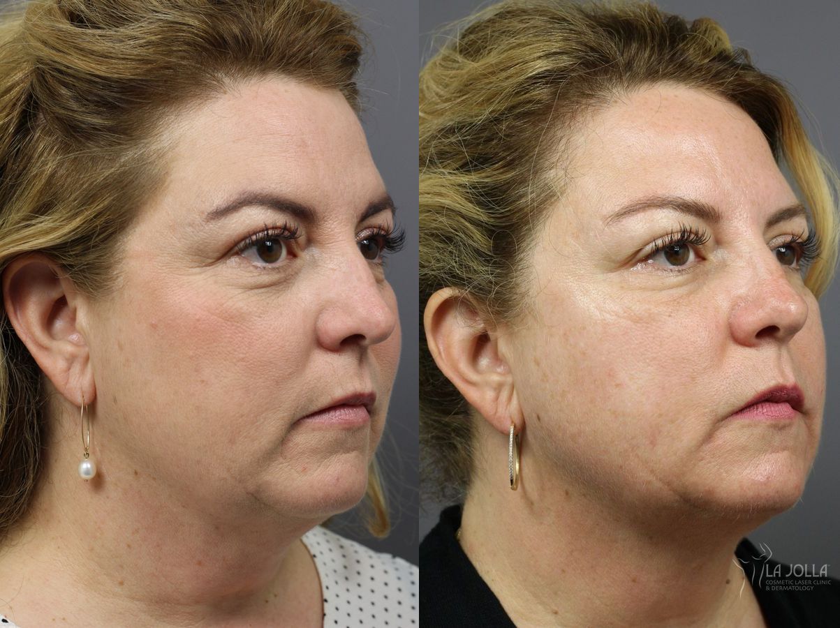 Before and after CoolSculpting® case 36214