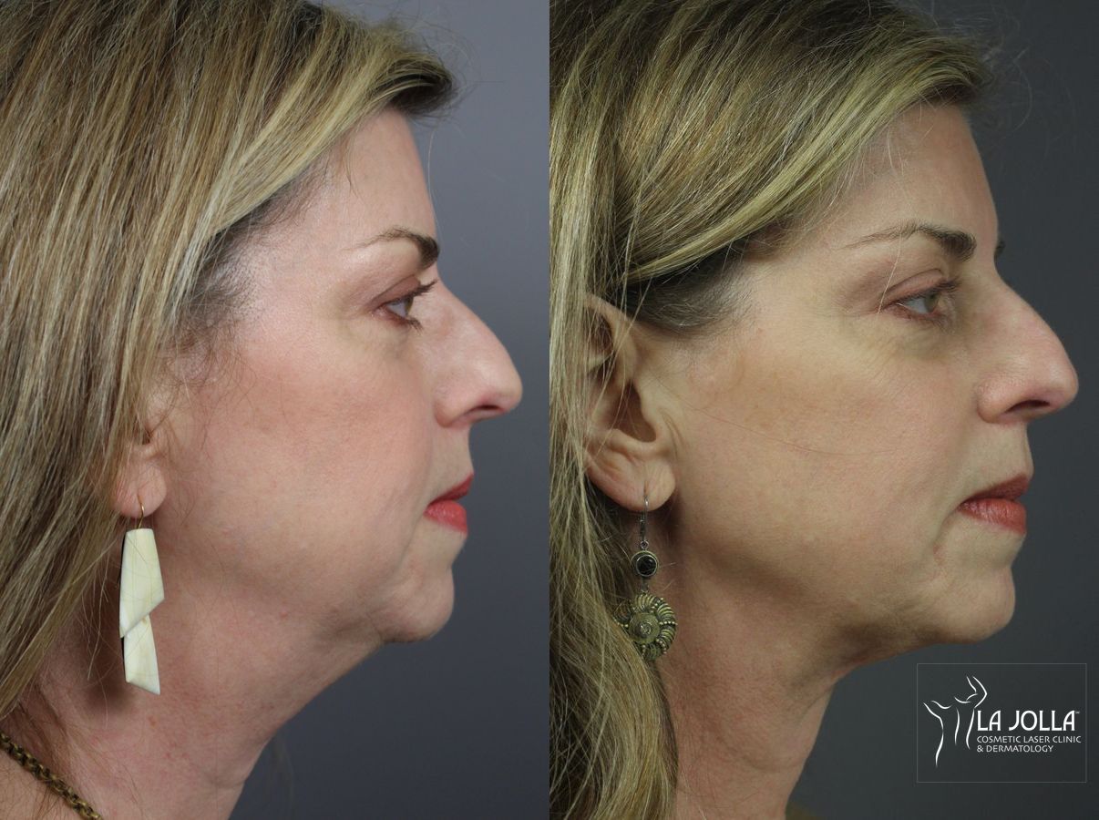 Before and after CoolSculpting® case 36084