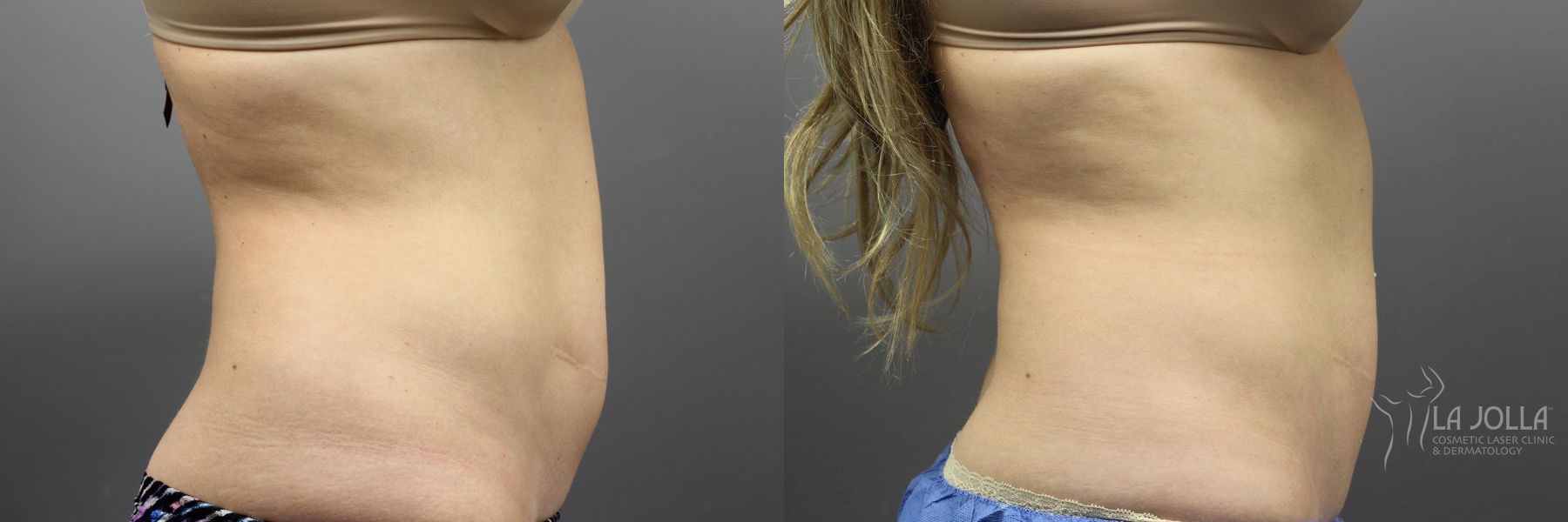 Before and after CoolSculpting® case 36101 - Angle 3