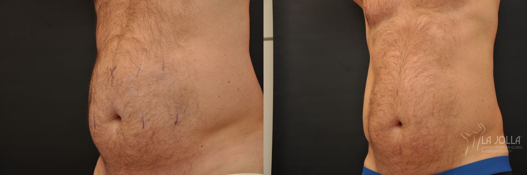 Before and after CoolSculpting® case 36272