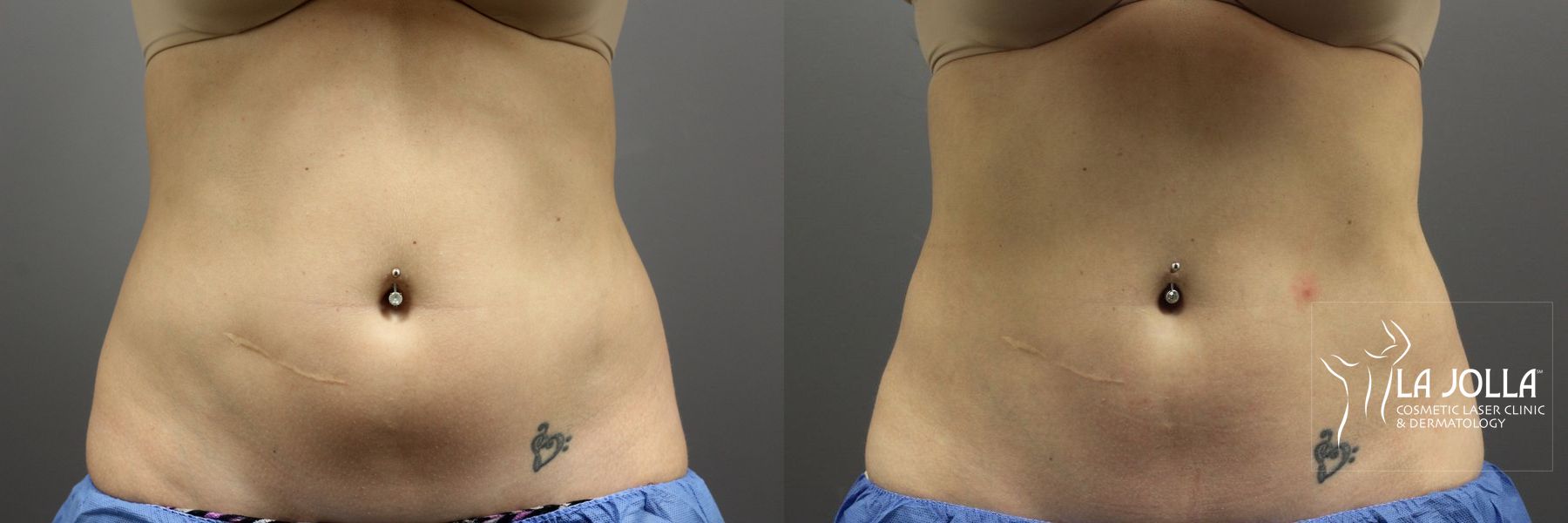Before and after CoolSculpting® case 36101 - Angle 2