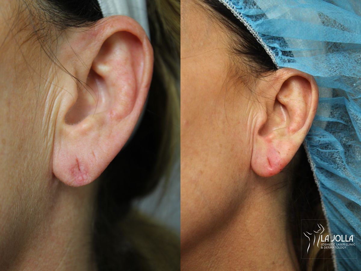 Before and after Dermal Filler case 36410