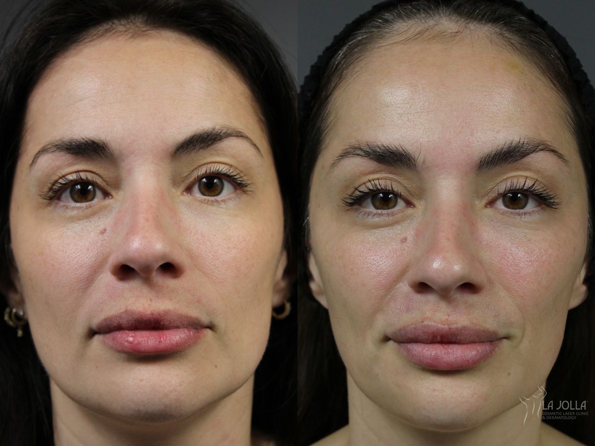Before and after Dermal Filler case 46323
