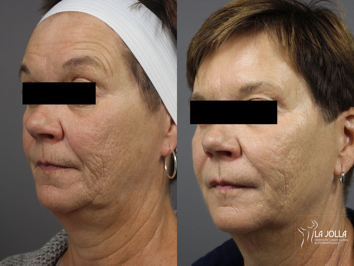 Before and after Dermal Filler case 36415